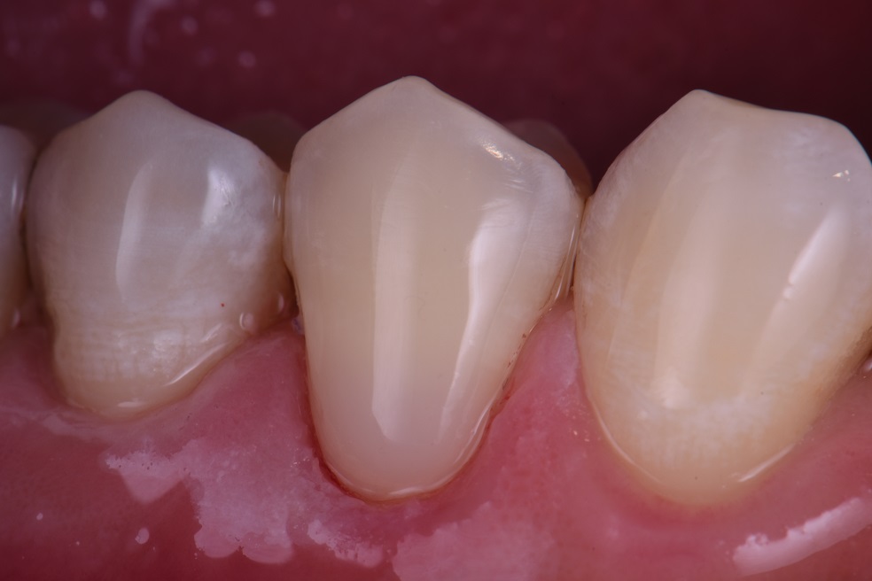 Cervical toothbrushing abrasion restored Cervical toothbrushing