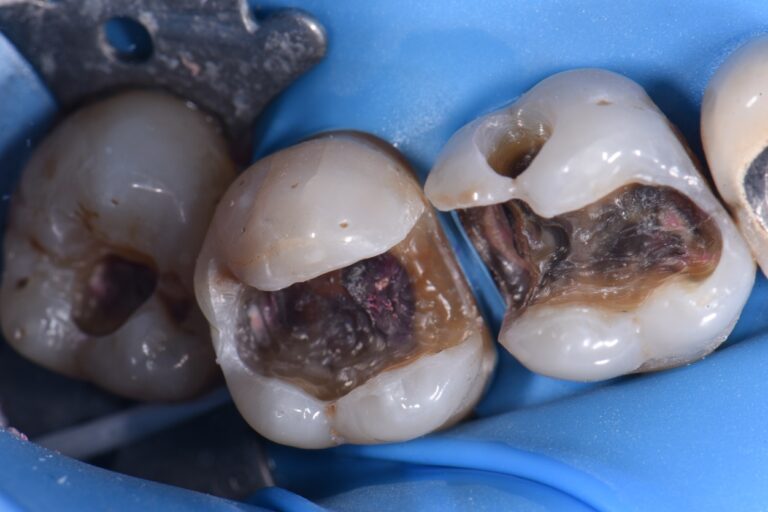Quadrant Dentistry Amalgam Removal Quadrant Dentistry Amalgam Removal