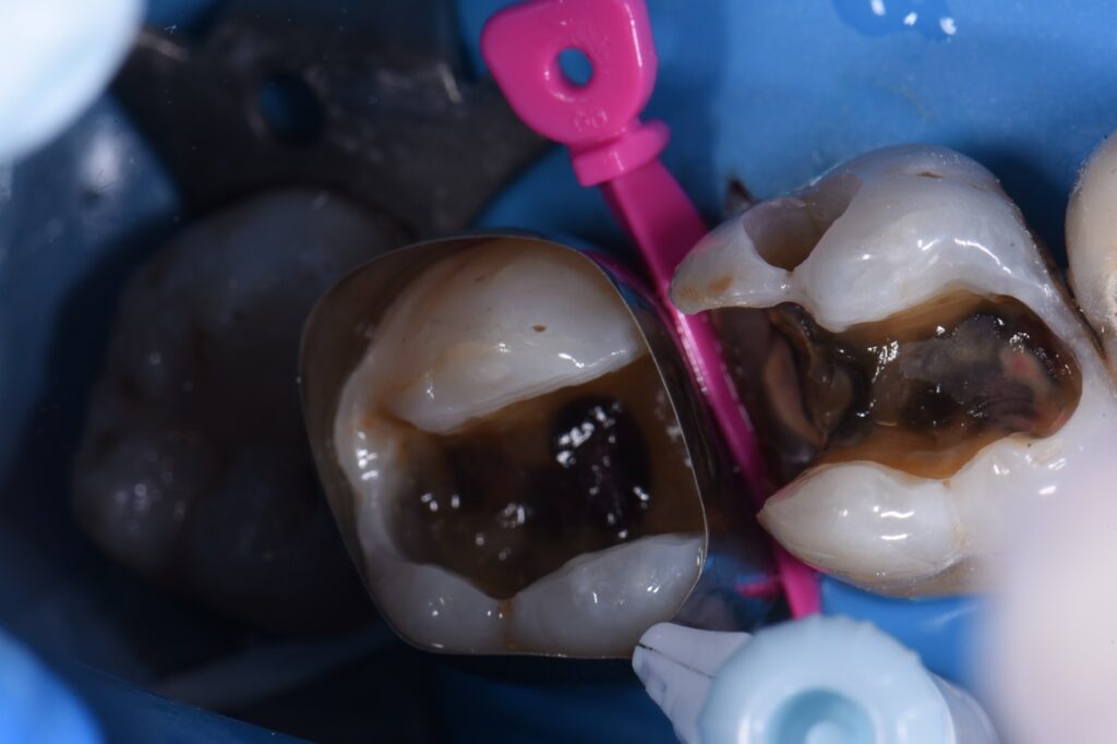 Quadrant Dentistry Amalgam Removal Quadrant Dentistry Amalgam Removal