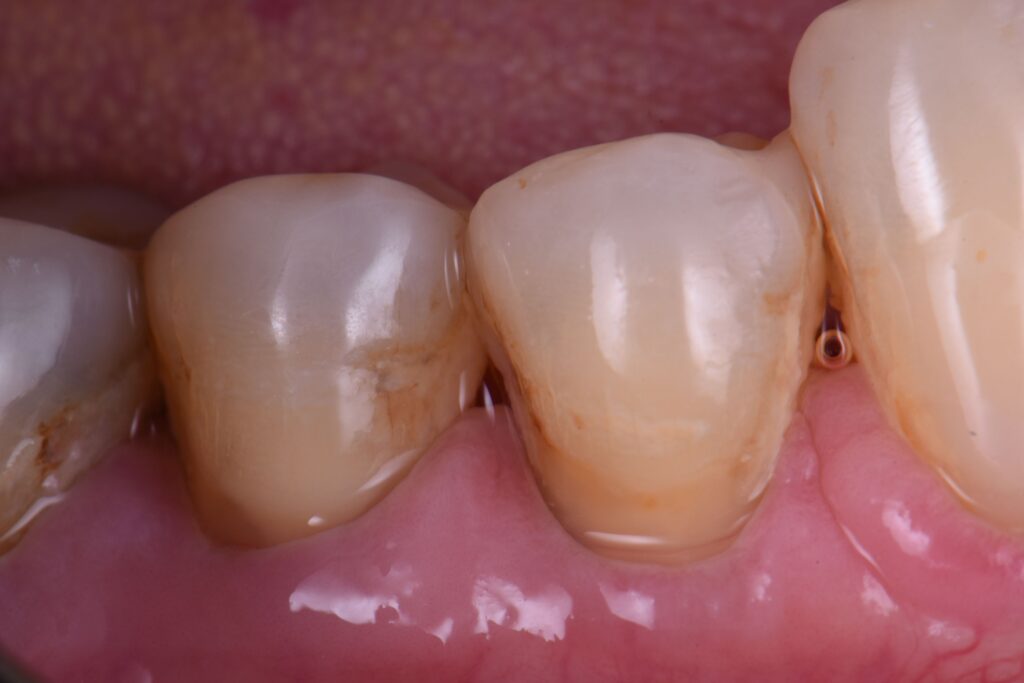 Restoring combination abrasion and hypocalcified enamel Restoring combination abrasion and