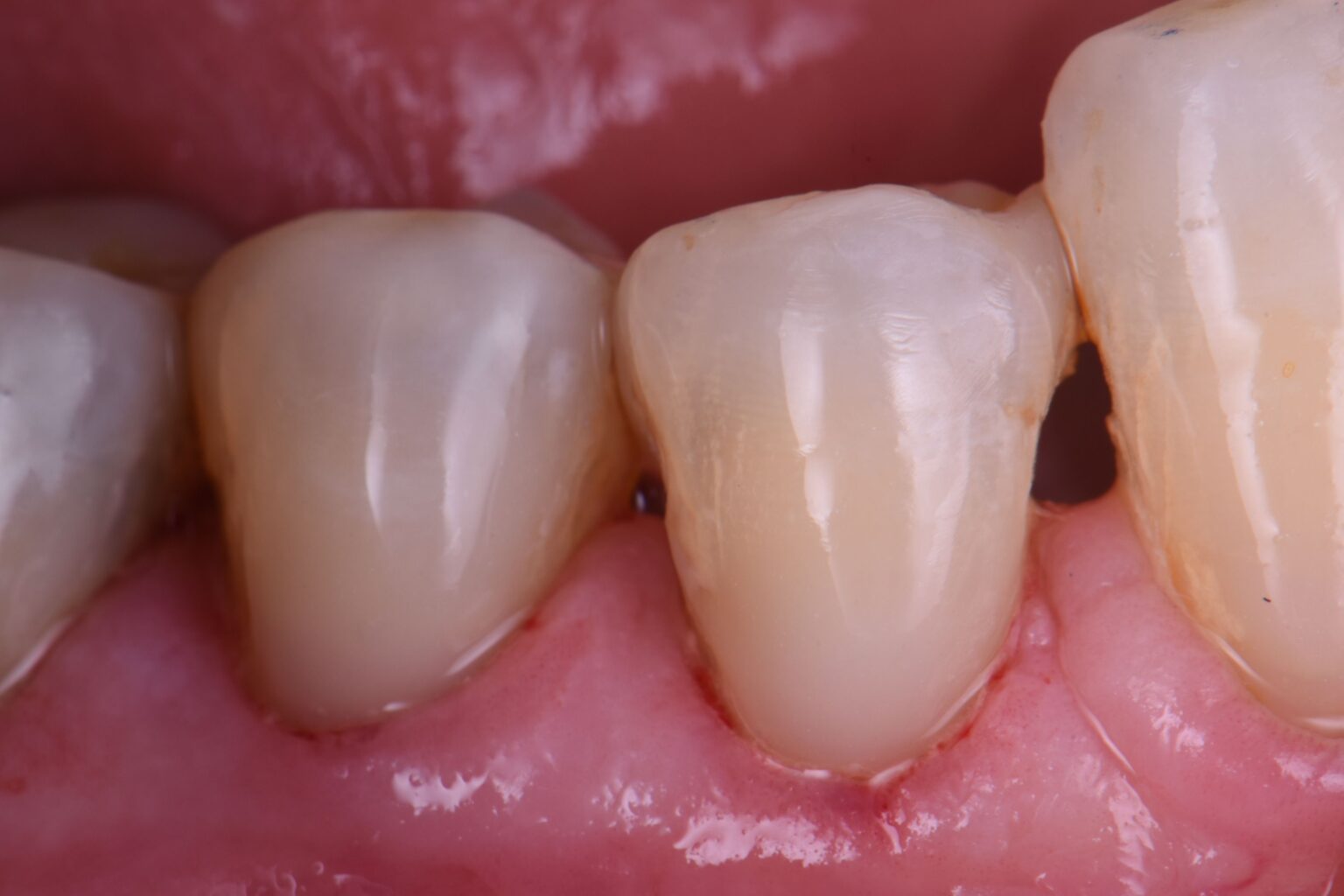 Restoring combination abrasion and hypocalcified enamel Restoring