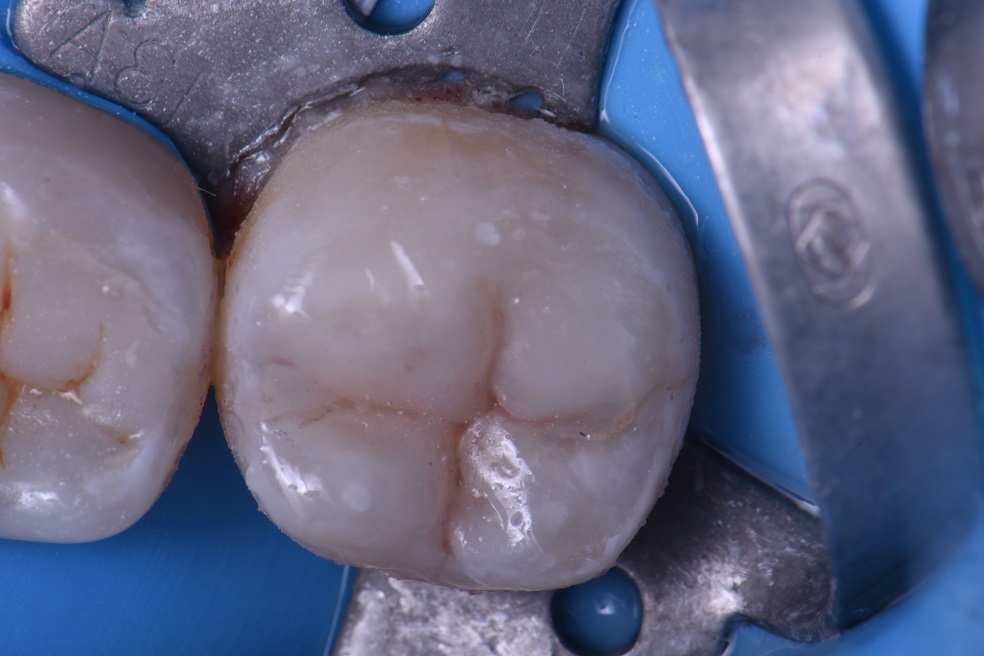 The Simple Occlusal Anatomy Form Posterior Composite The Simple