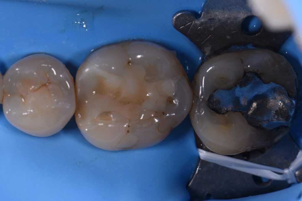 Biomimetic Quadrant Dentistry with Tetric Prime Biomimetic Quadrant