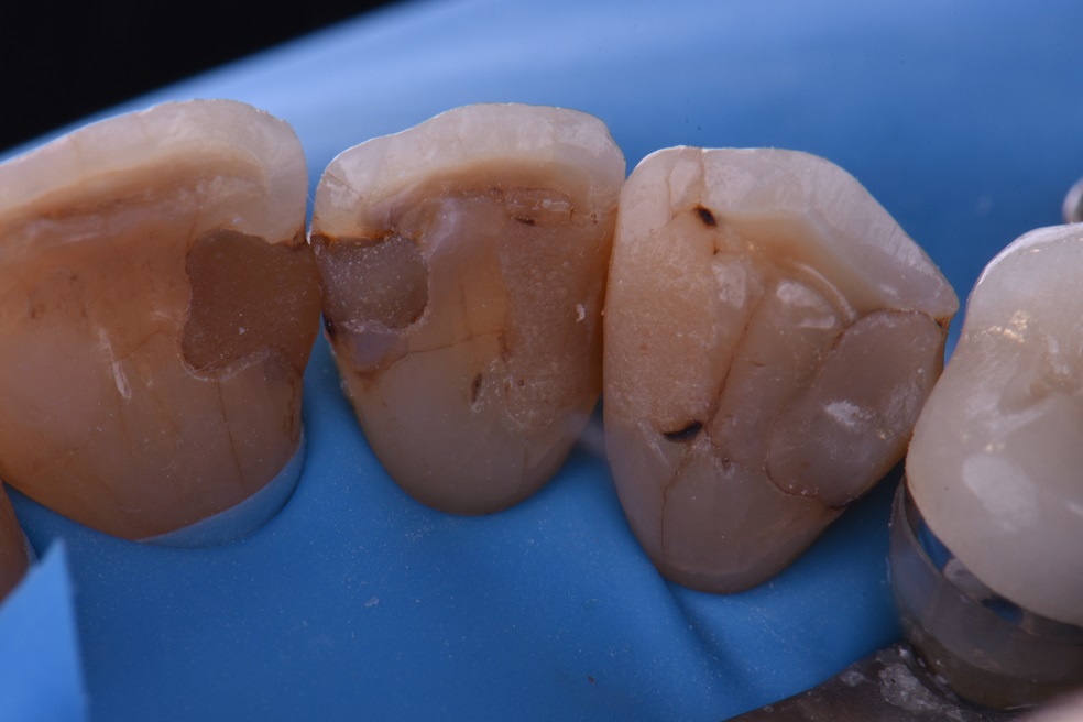 Class III resin restoration replacements Class III resin restoration