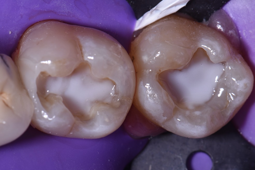 Kerr Simplishade Composite Posterior Artistry Kerr Simplishade