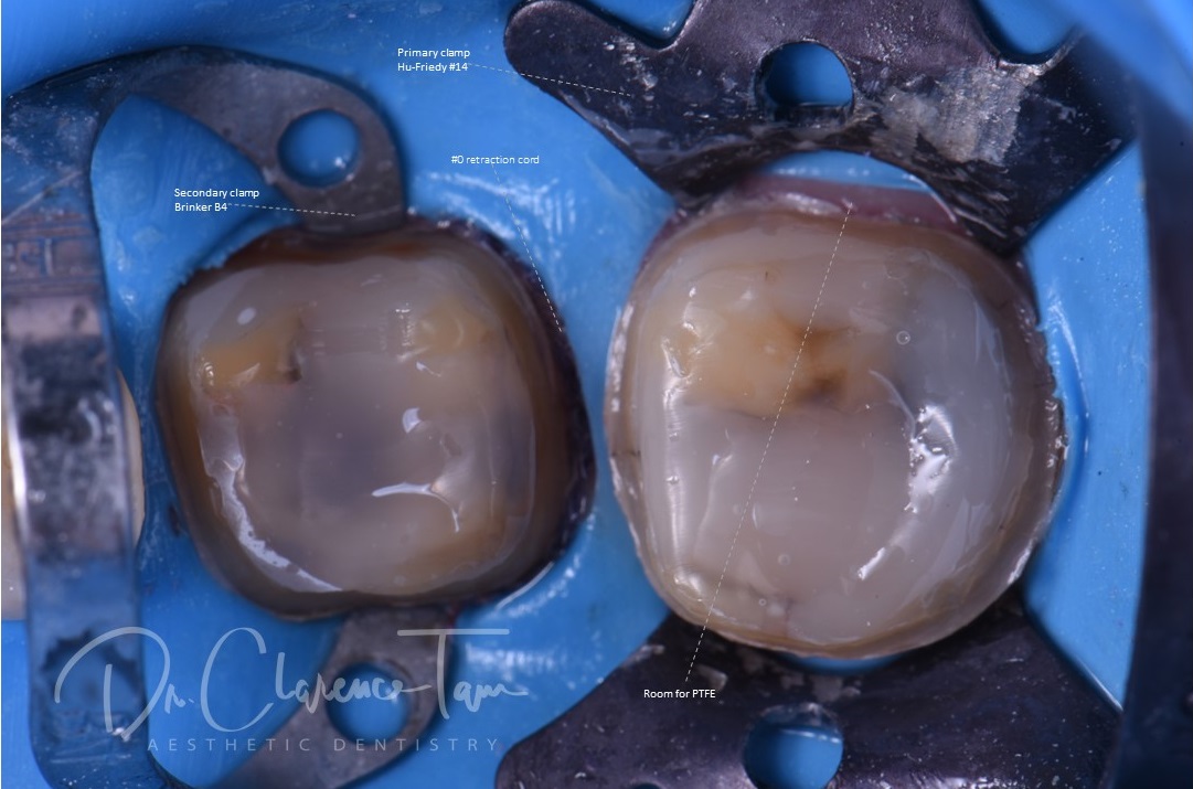 Achieving Absolute Isolation in Restorative Dentistry