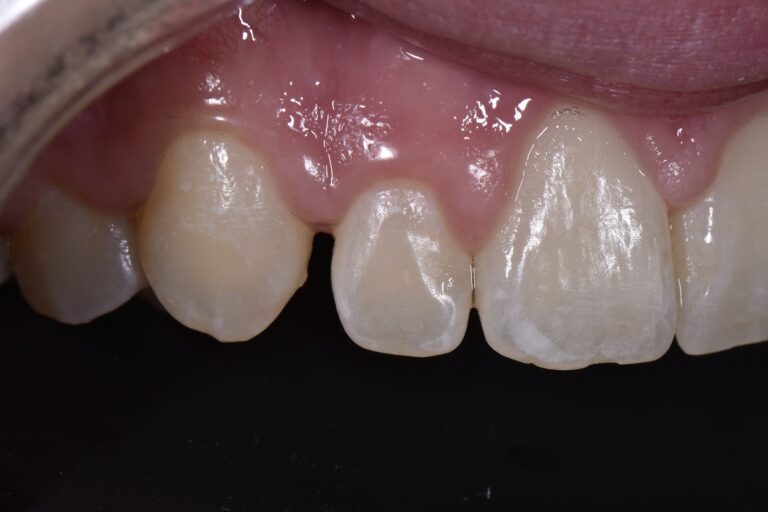Peg Lateral Augmentation with Composite Veneer Peg Lateral Augmentation ...