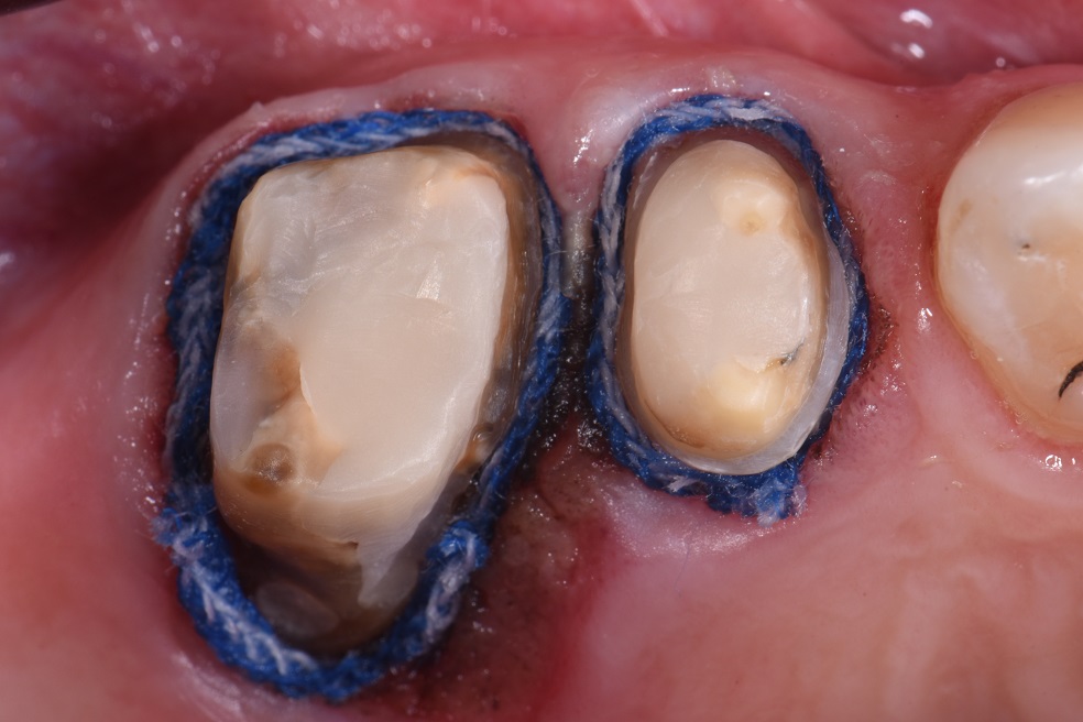 Old Crown Replacements with new bonded crowns Old Crown Replacements