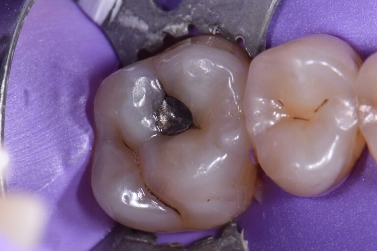 Dental Amalgam Removal Services Amalgam Removal Services