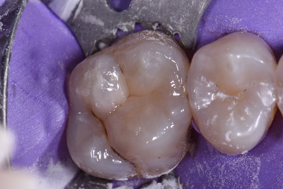 Dental Amalgam Removal Services Amalgam Removal Services