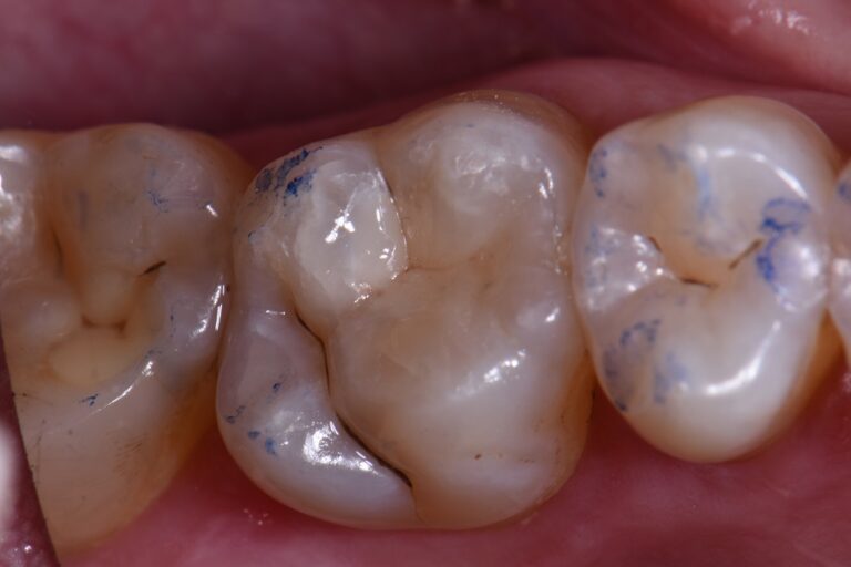 Dental Amalgam Removal Services Amalgam Removal Services