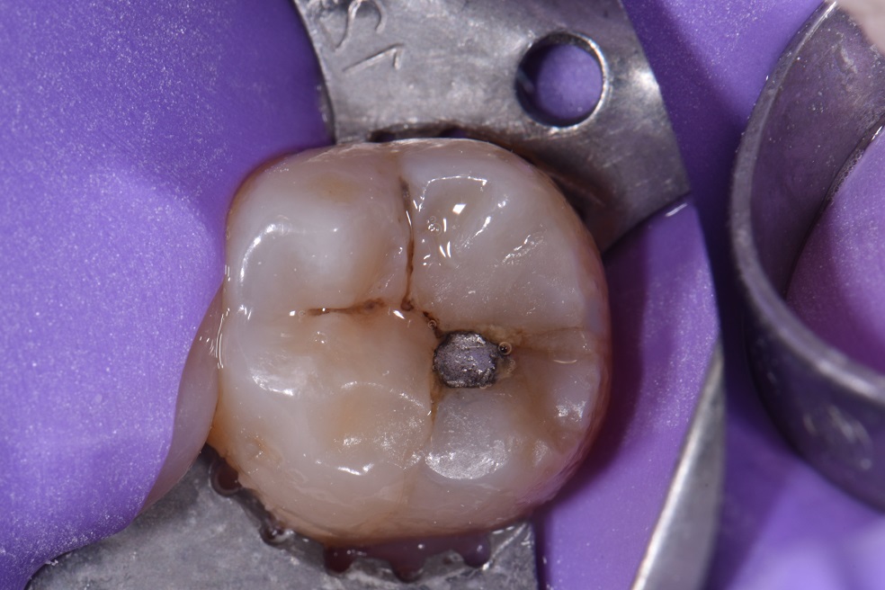 Small dental amalgam replacement restorations Small dental amalgam