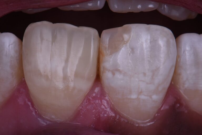 Class IV sequence Direct Composite Artistry Dehydrated Tooth Class IV