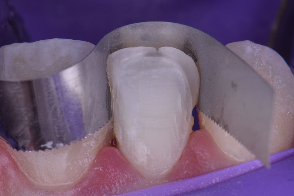 Composite Veneers Auckland Voco Amaris Composite Veneers Auckland Voco Amaris