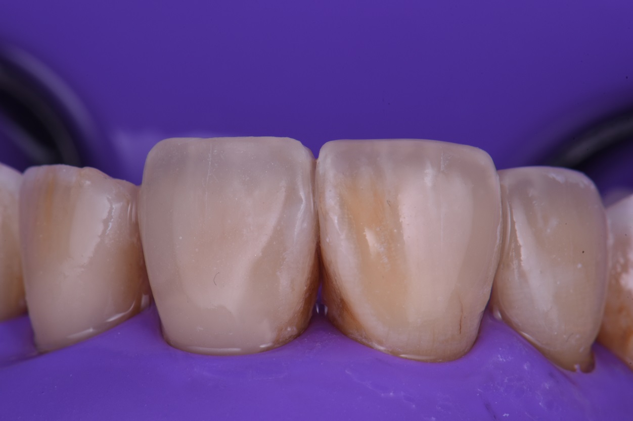 Partial Composite Veneers to reconstruct broken front teeth Partial