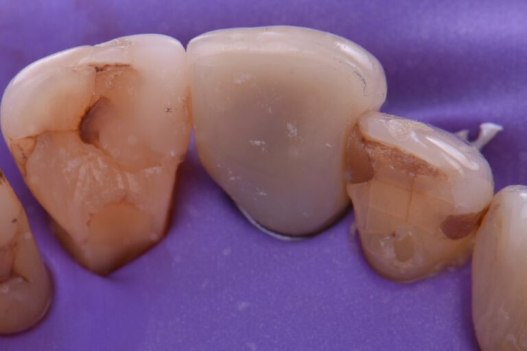 Adaptive Occlusal Wear with Secondary Occlusal Traumatism Adaptive