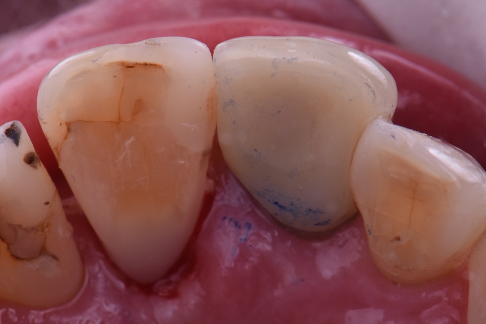 Adaptive Occlusal Wear with Secondary Occlusal Traumatism Adaptive