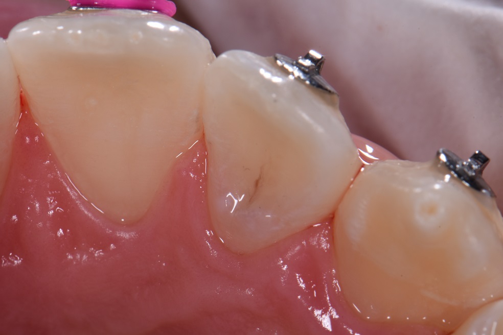 Dens Invaginatus Dens in dente restoration Dens Invaginatus Dens in