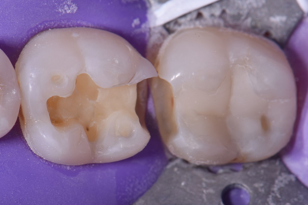 Testing New Dental Chameleon Composites Testing New Dental Chameleon Composites