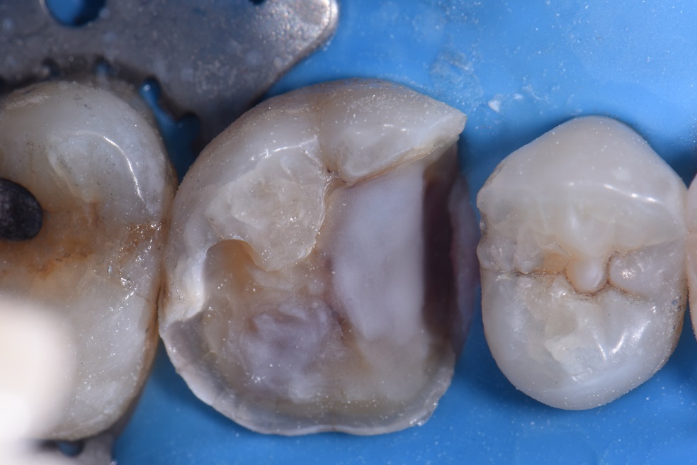 Bonded Dental Onlays and Overlays Auckland Dental Onlays and Overlays