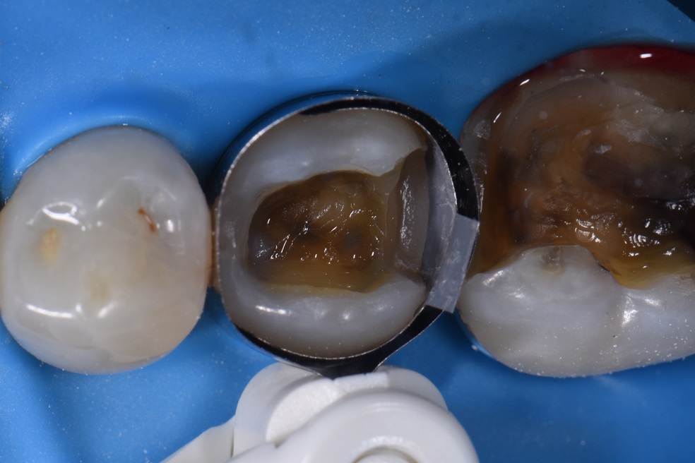 Auckland Cosmetic Dentistry Premolar Composite Restorations Auckland