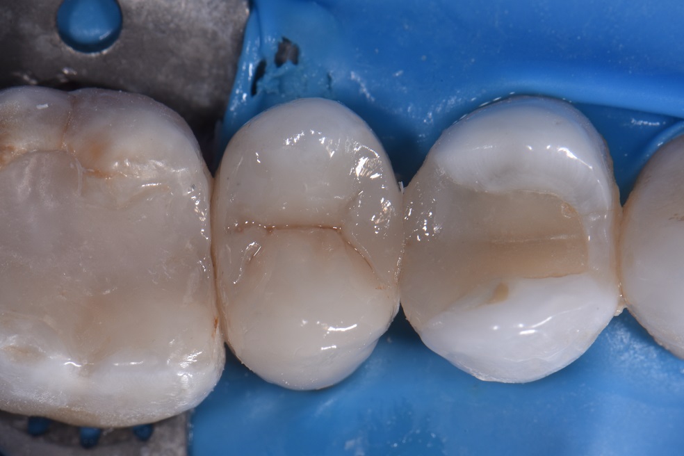 Premolar Composite Onlays and Overlays Premolar Composite Onlays and