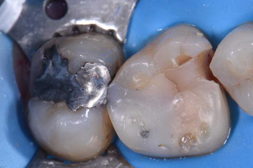 Dental Amalgam Removal Auckland Dental Amalgam Removal Auckland