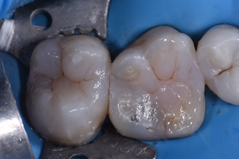 Dental Amalgam Removal Auckland Dental Amalgam Removal Auckland