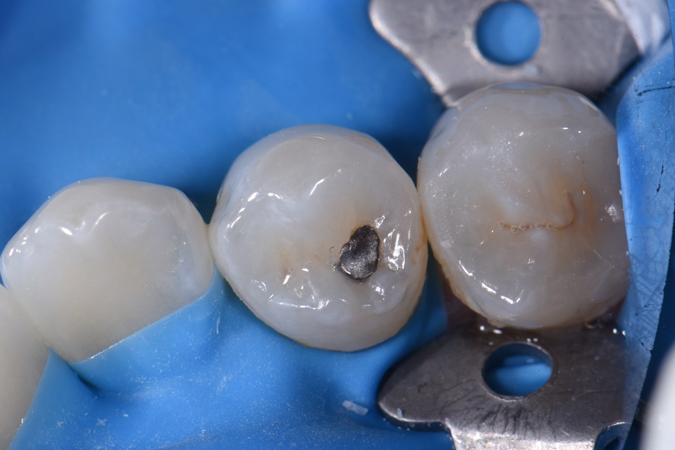 Dental Amalgam Removal Dental Amalgam Removal
