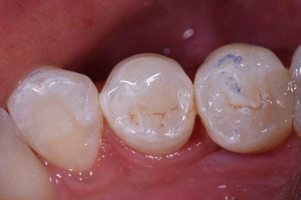 Dental Amalgam Removal Dental Amalgam Removal