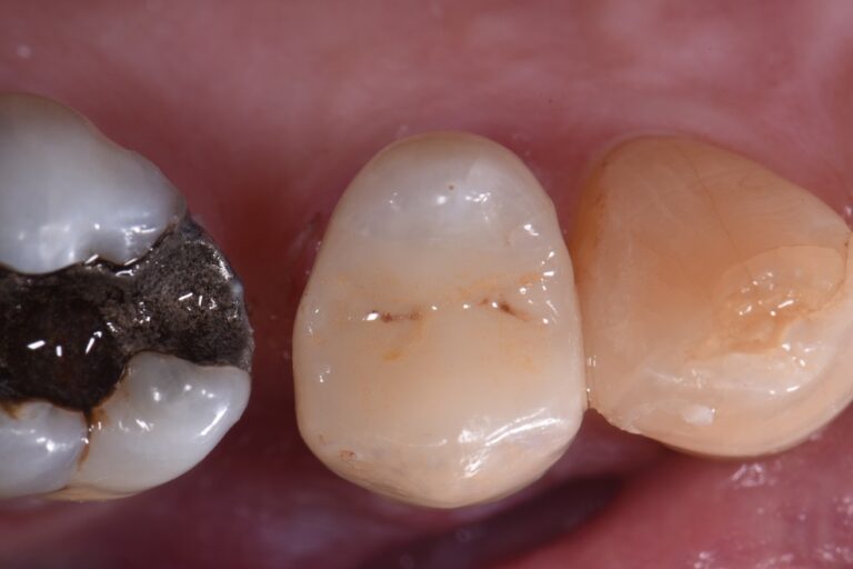Auckland Dental Overlays Onlays Auckland Dental Overlays Onlays