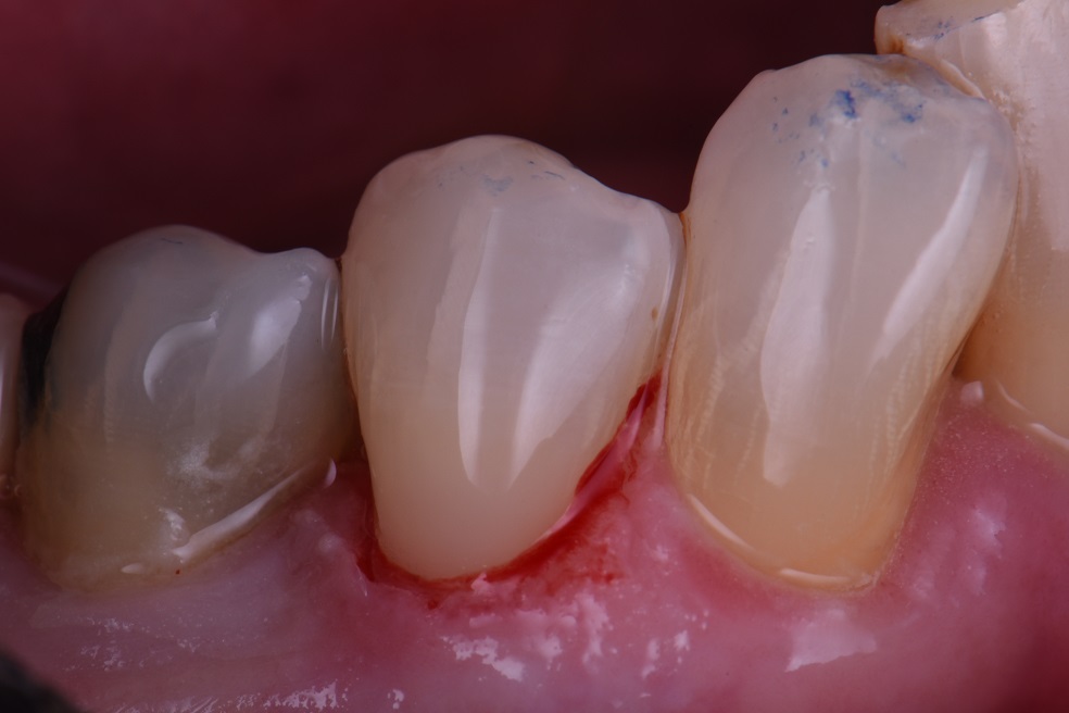Desensitizing Root Surfaces Desensitizing Root Surfaces