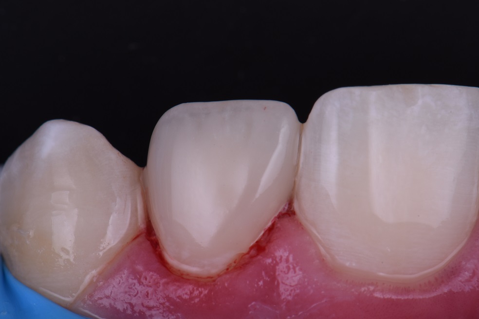 Layered non invasive composite veneers Layered non invasive composite