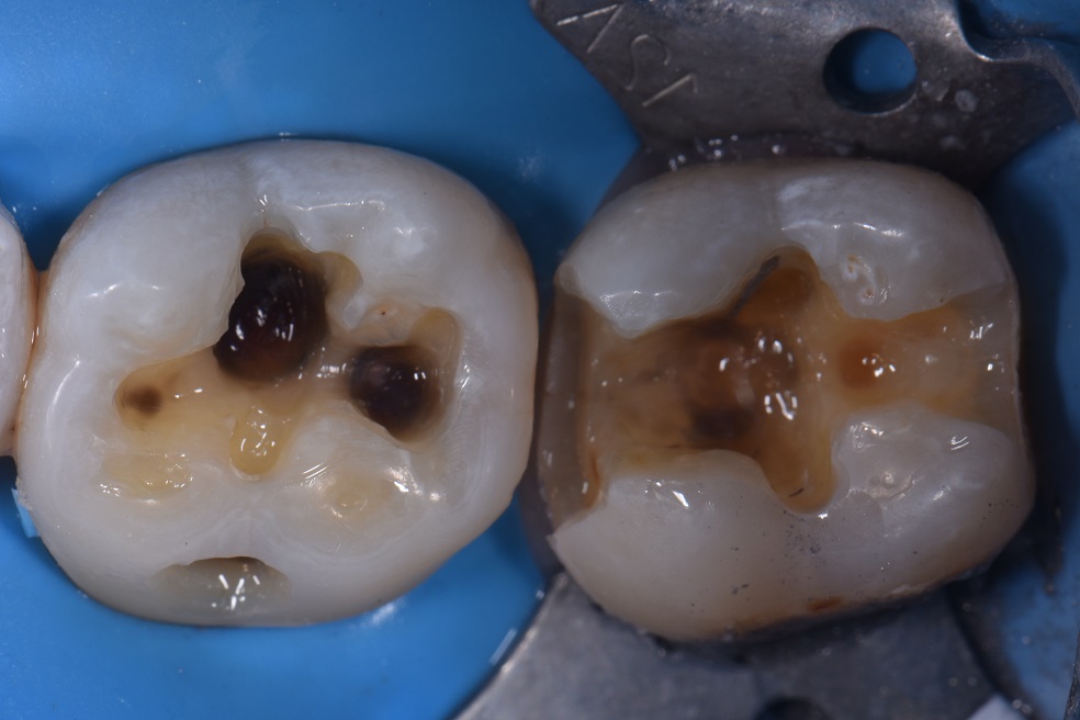 Dental Amalgam Removal Auckland Dental Amalgam Removal Auckland