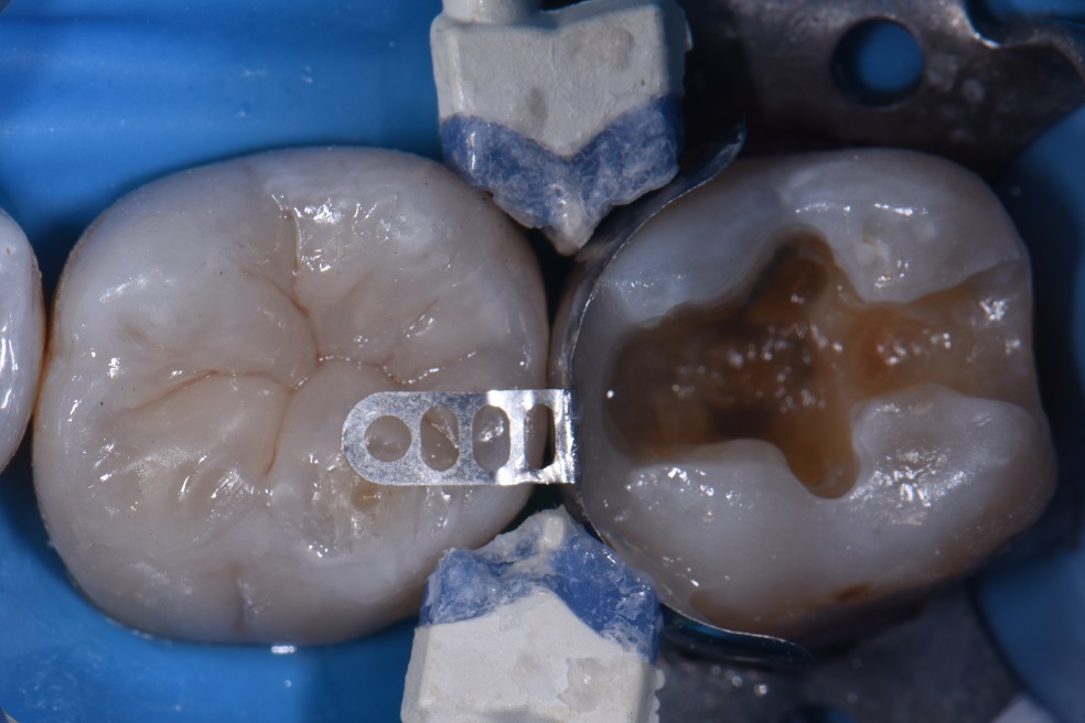 Dental Amalgam Removal Auckland Dental Amalgam Removal Auckland