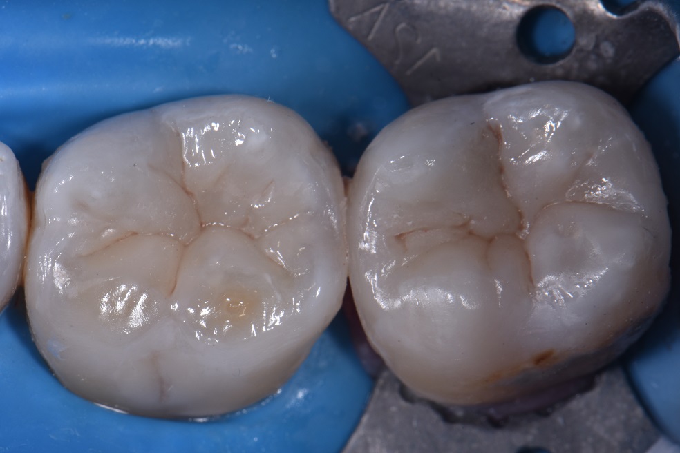 Dental Amalgam Removal Auckland Dental Amalgam Removal Auckland