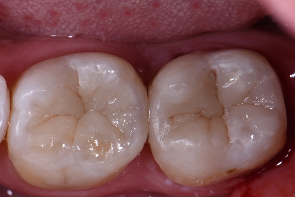 Dental Amalgam Removal Auckland Dental Amalgam Removal Auckland