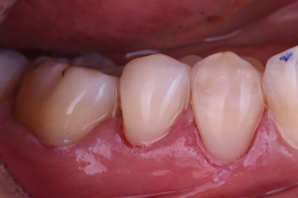 Milled toothbrush abrasion lesions reversed