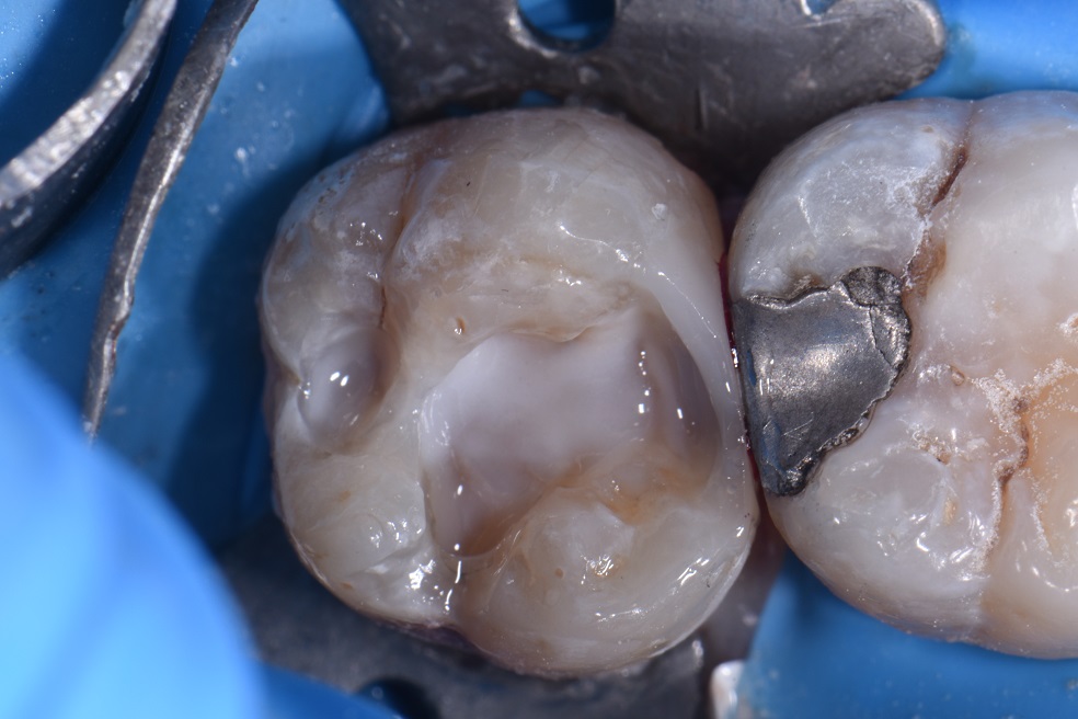 Extensive cavity with existing composite Extensive cavity with existing