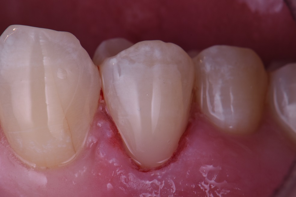 Cervical Abrasion Lesions Cervical Abrasion Lesions