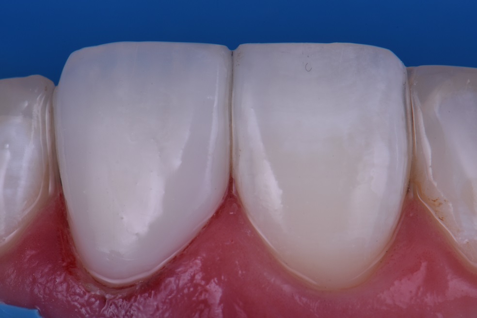Seamless Anterior Composite Restorations Seamless Anterior Composite