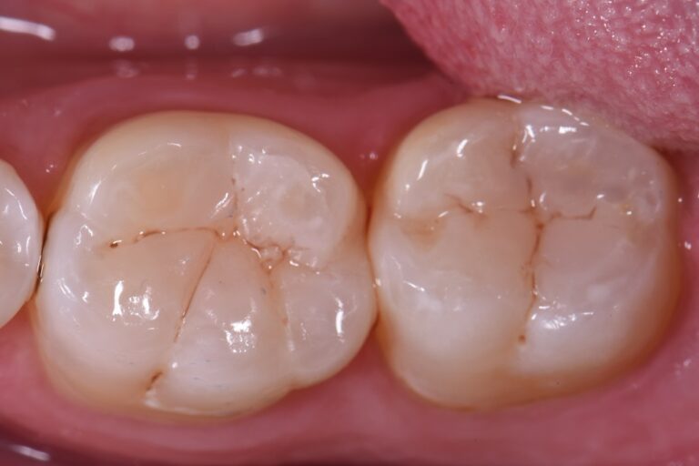 Blend of Universal Dental Composites Blend of Universal Dental Composites