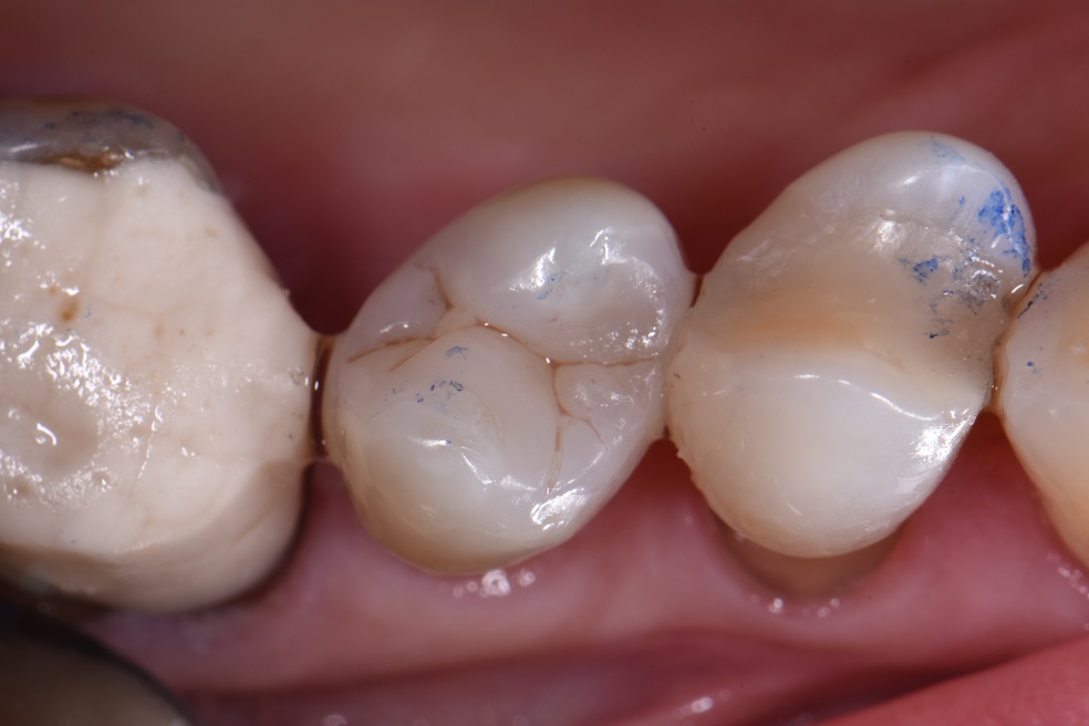 Dental Amalgam Removal Service Auckland Dental Amalgam Removal Service