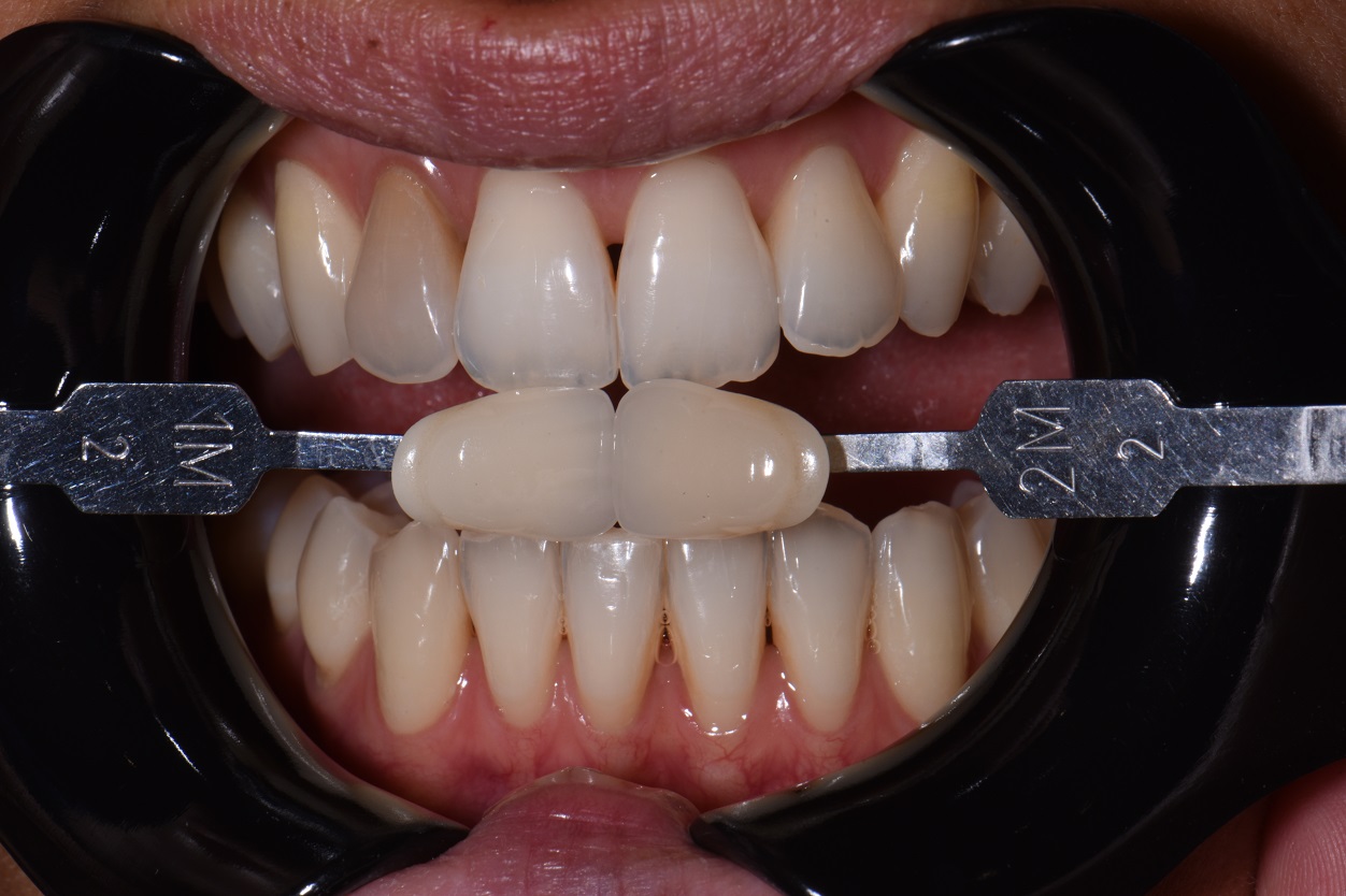 Teeth Whitening Auckland Teeth Whitening Auckland