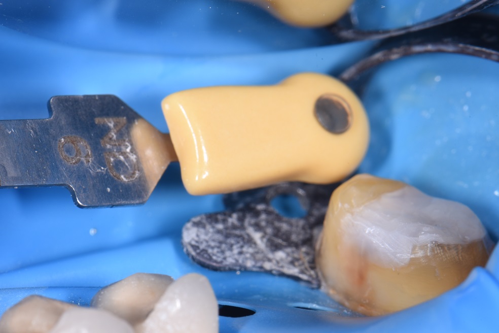 Dental Crowns Onlays and Overlays Dental Crowns Onlays and Overlays