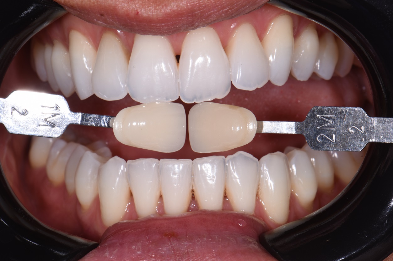 Teeth Whitening Auckland Teeth Whitening Auckland