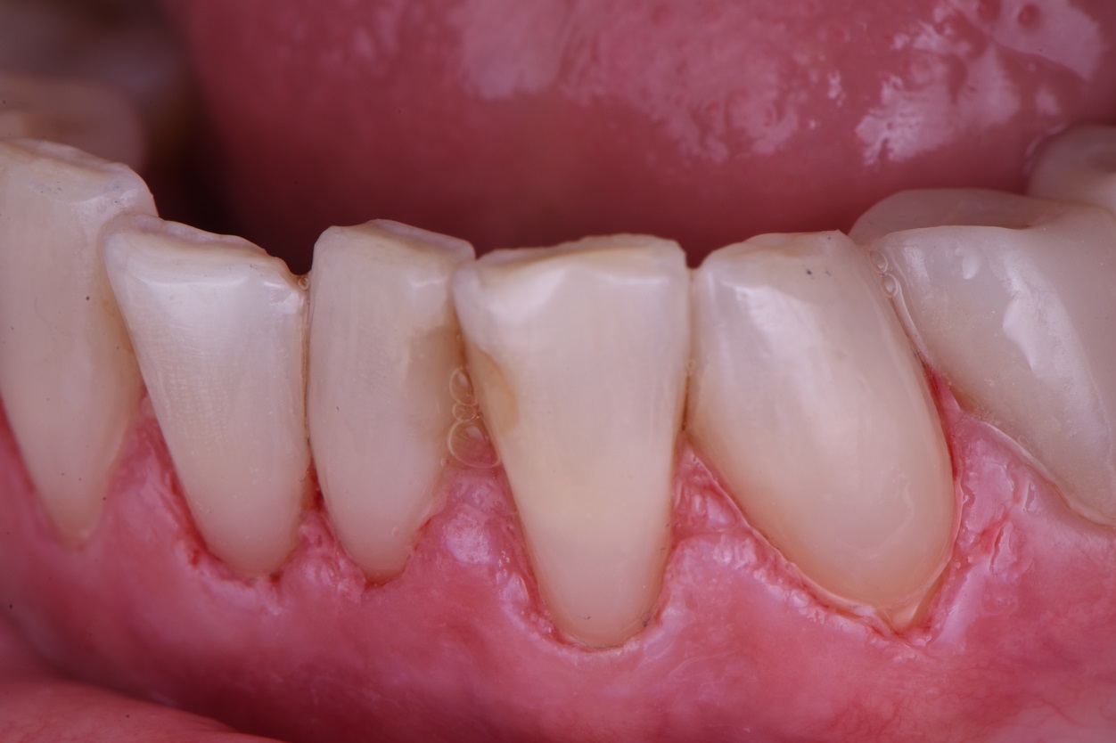 Class V Restorations