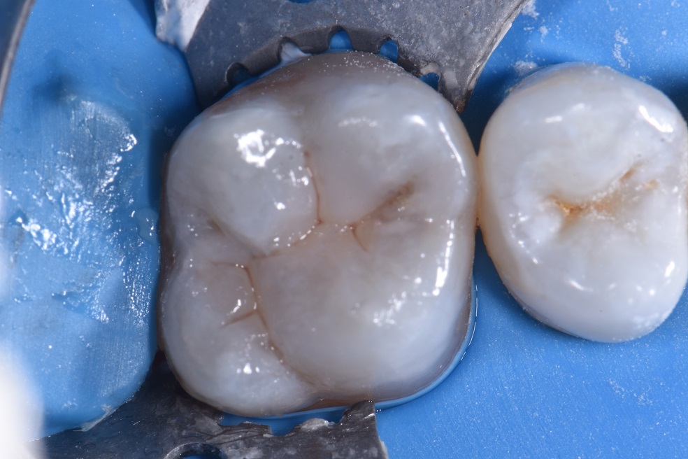 Amalgam Removal and Composite Restorations