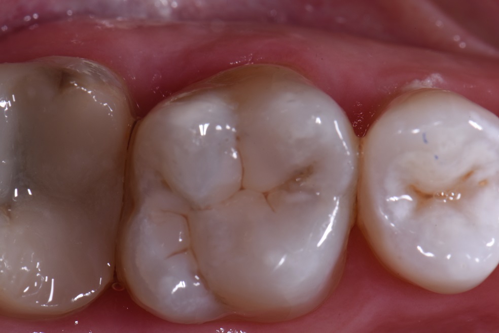 Amalgam Removal and Composite Restorations