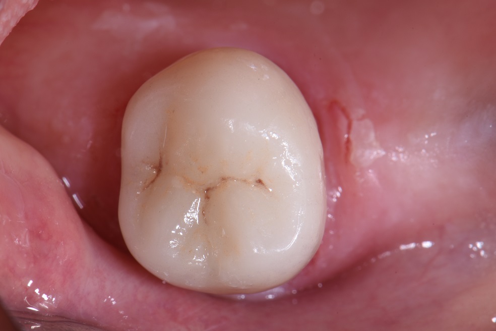 Dental Crowns Onlays and Overlays Dental Crowns Onlays and Overlays